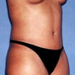 Tummy Tuck - Abdominoplasty Before & After Patient #293