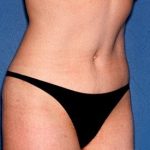 Tummy Tuck - Abdominoplasty Before & After Patient #259