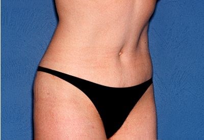 Tummy Tuck - Abdominoplasty Before & After Patient #259