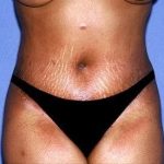Tummy Tuck - Abdominoplasty Before & After Patient #131