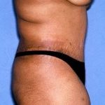 Tummy Tuck - Abdominoplasty Before & After Patient #131