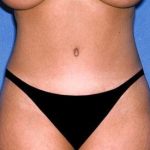 Tummy Tuck - Abdominoplasty Before & After Patient #383