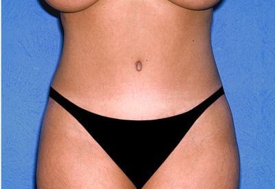 Tummy Tuck - Abdominoplasty Before & After Patient #383