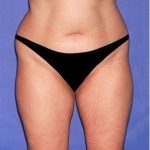 Tummy Tuck - Abdominoplasty Before & After Patient #326