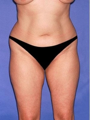 Tummy Tuck - Abdominoplasty Before & After Patient #326