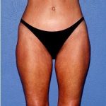 Tummy Tuck - Abdominoplasty Before & After Patient #371