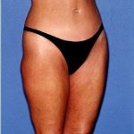Tummy Tuck - Abdominoplasty Before & After Patient #371