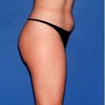 Tummy Tuck - Abdominoplasty Before & After Patient #606