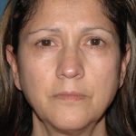 Upper & Lower Facelift - Brow Lift & Face/Neck Lift Before & After Patient #2638