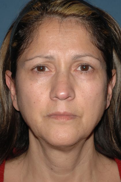 Facelift - Face/Neck (Lower) Before & After Patient #2638