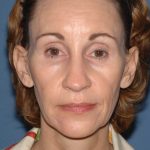 Upper & Lower Facelift - Brow Lift & Face/Neck Lift Before & After Patient #2639
