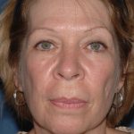 Upper & Lower Facelift - Brow Lift & Face/Neck Lift Before & After Patient #2641