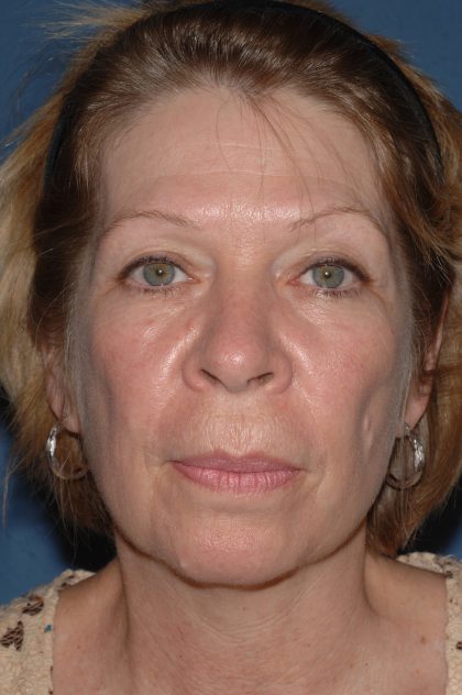 Facelift - Face/Neck (Lower) Before & After Patient #2641