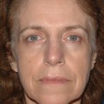 Upper & Lower Facelift - Brow Lift & Face/Neck Lift Before & After Patient #2642