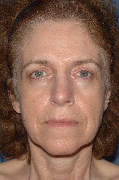 Facelift - Face/Neck (Lower) Before & After Patient #2642