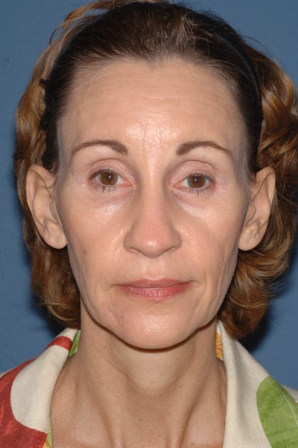 Facelift - Face/Neck (Lower) Before & After Patient #2639