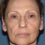 Upper & Lower Facelift - Brow Lift & Face/Neck Lift Before & After Patient #2640