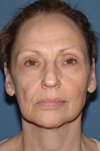 Facelift - Face/Neck (Lower) Before & After Patient #2640