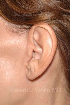 Facelift - Face/Neck (Lower) Before & After Patient #2639