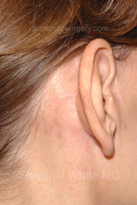 Facelift - Face/Neck (Lower) Before & After Patient #2639
