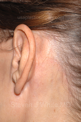 Facelift - Face/Neck (Lower) Before & After Patient #2639