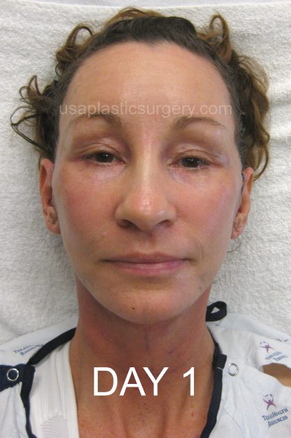 Facelift - Face/Neck (Lower) Before & After Patient #2639