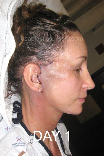 Facelift - Face/Neck (Lower) Before & After Patient #2639
