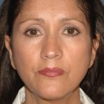Upper & Lower Facelift - Brow Lift & Face/Neck Lift Before & After Patient #2638