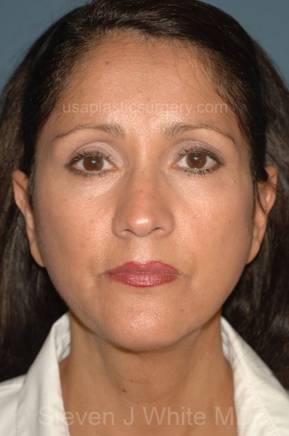 Facelift - Face/Neck (Lower) Before & After Patient #2638
