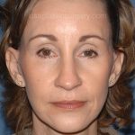 Upper & Lower Facelift - Brow Lift & Face/Neck Lift Before & After Patient #2639