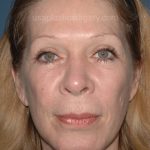 Upper & Lower Facelift - Brow Lift & Face/Neck Lift Before & After Patient #2641