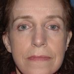 Upper & Lower Facelift - Brow Lift & Face/Neck Lift Before & After Patient #2642
