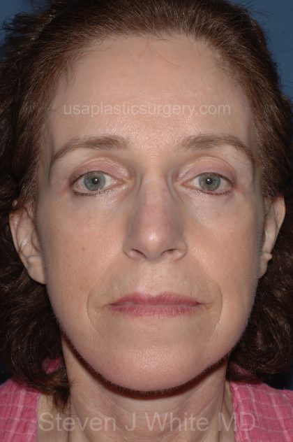 Facelift - Face/Neck (Lower) Before & After Patient #2642