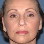 Upper & Lower Facelift - Brow Lift & Face/Neck Lift Before & After Patient #2640