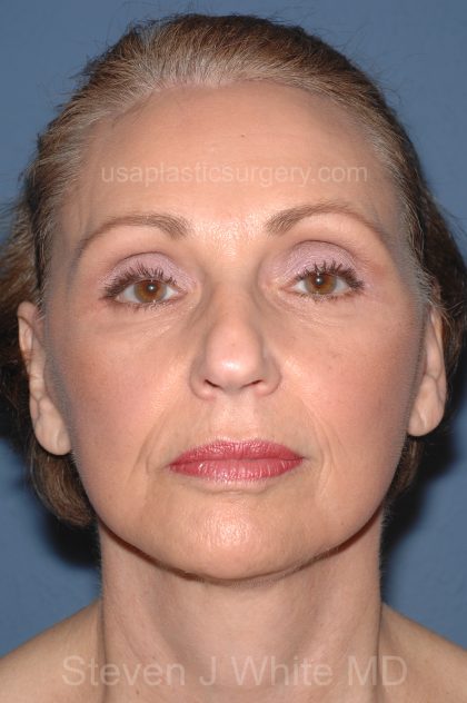 Facelift - Face/Neck (Lower) Before & After Patient #2640