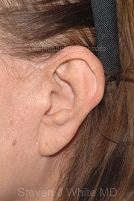 Facelift - Face/Neck (Lower) Before & After Patient #2643