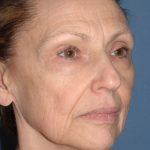 Upper & Lower Facelift - Brow Lift & Face/Neck Lift Before & After Patient #2640