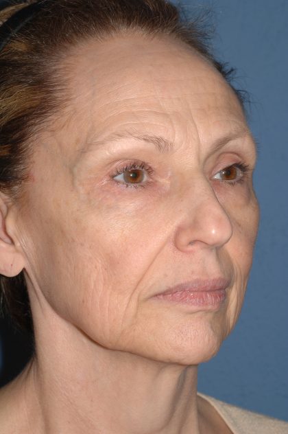 Facelift - Face/Neck (Lower) Before & After Patient #2640