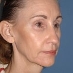 Upper & Lower Facelift - Brow Lift & Face/Neck Lift Before & After Patient #2639