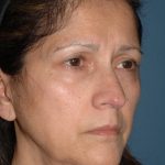 Upper & Lower Facelift - Brow Lift & Face/Neck Lift Before & After Patient #2638