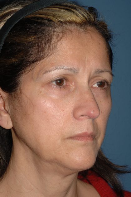 Facelift - Face/Neck (Lower) Before & After Patient #2638