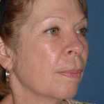 Upper & Lower Facelift - Brow Lift & Face/Neck Lift Before & After Patient #2641