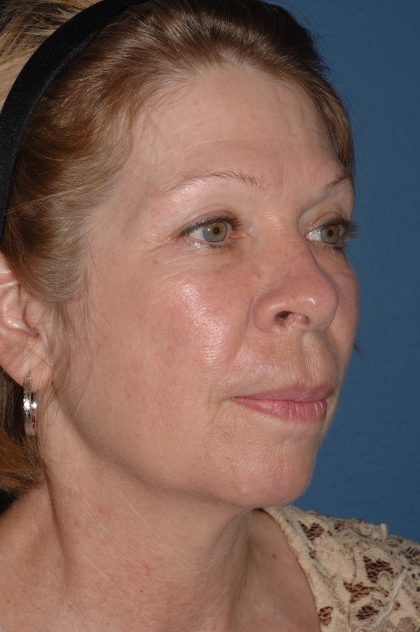 Facelift - Face/Neck (Lower) Before & After Patient #2641