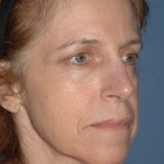 Upper & Lower Facelift - Brow Lift & Face/Neck Lift Before & After Patient #2642