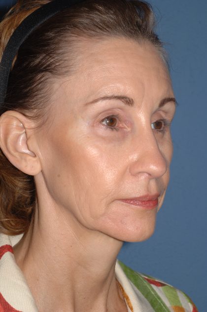 Facelift - Face/Neck (Lower) Before & After Patient #2639