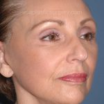 Upper & Lower Facelift - Brow Lift & Face/Neck Lift Before & After Patient #2640