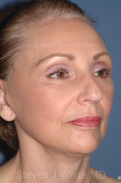 Facelift - Face/Neck (Lower) Before & After Patient #2640