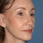 Upper & Lower Facelift - Brow Lift & Face/Neck Lift Before & After Patient #2639