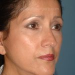 Upper & Lower Facelift - Brow Lift & Face/Neck Lift Before & After Patient #2638