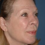 Upper & Lower Facelift - Brow Lift & Face/Neck Lift Before & After Patient #2641
